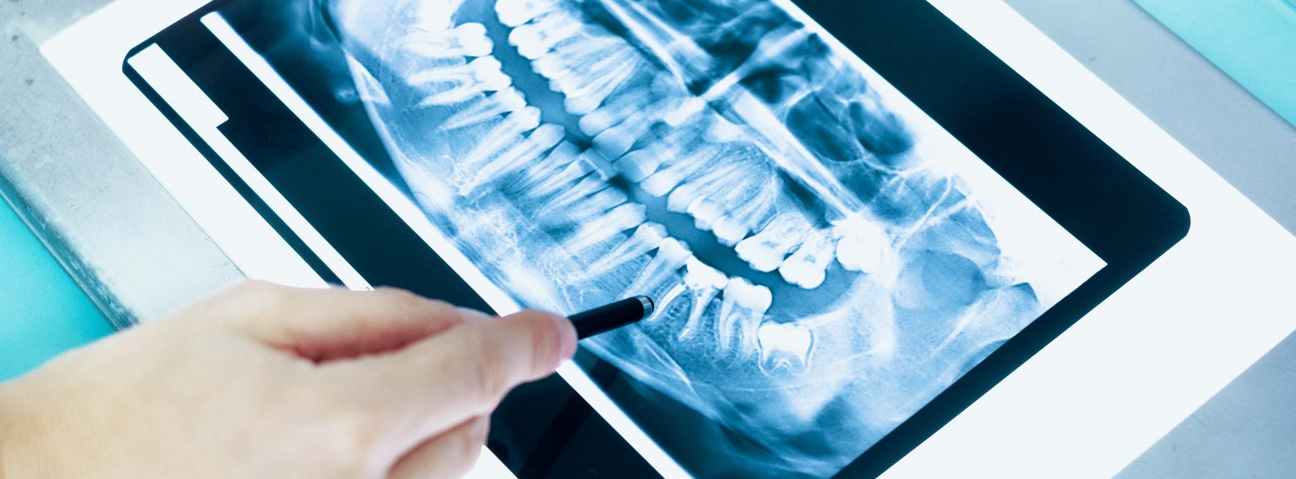 Dental x-ray and dentist hands